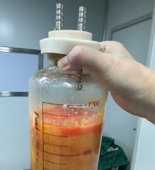 高平水动力吸脂手术要做多久？